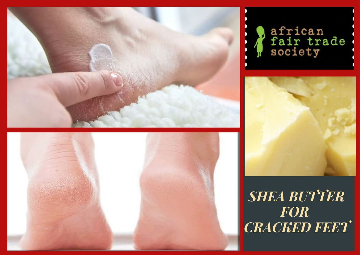 Cocoa butter for deals cracked heels